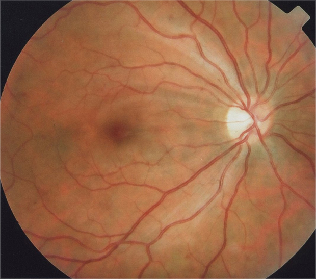 Fondo de ojo derecho